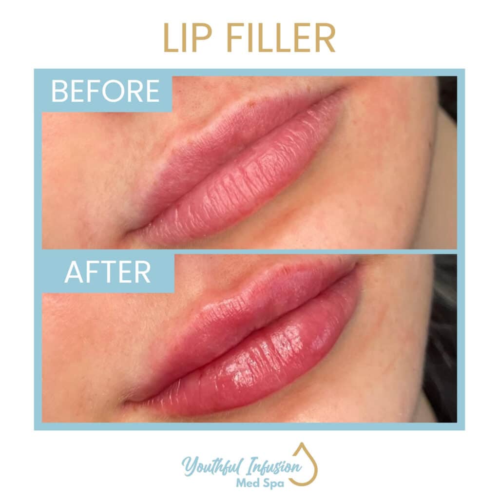 best lip filler near me allen texas med spa 63d91f1ec6927