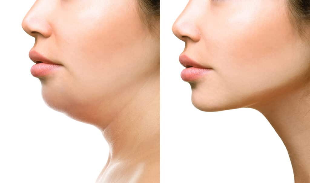 kybella double chin eliminator 63d91a7e3680f