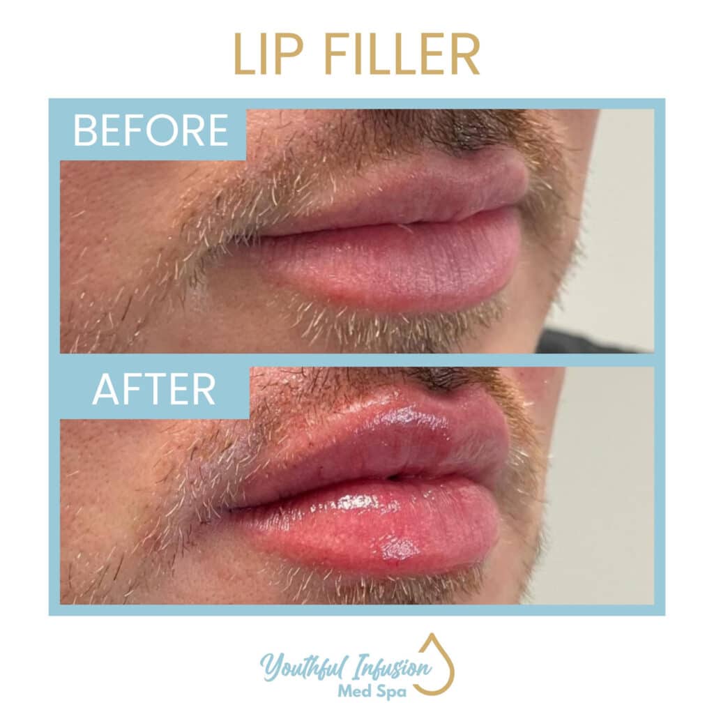 lip filler before and after in allen texas 63d91f30c9cdf