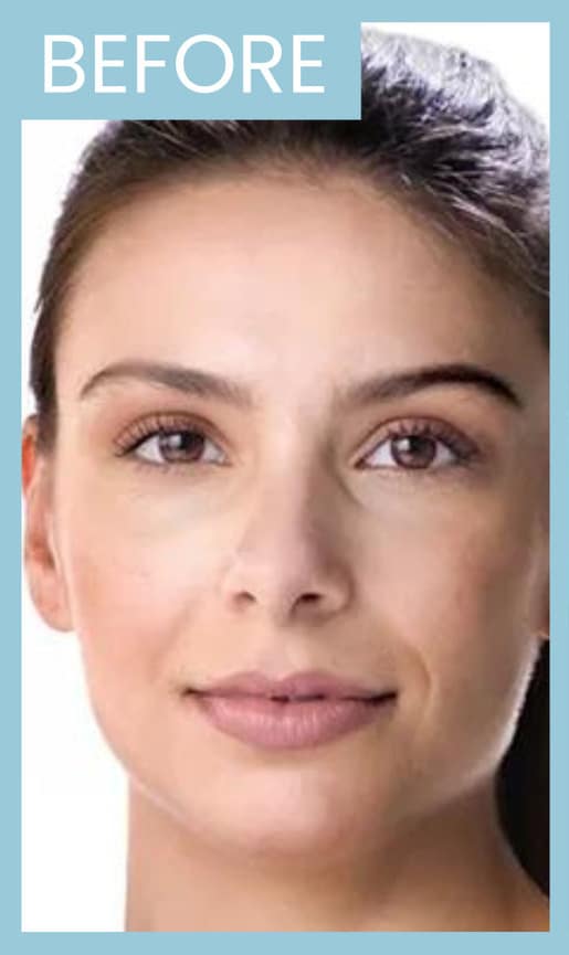 Before Image: Dermal Filler - front