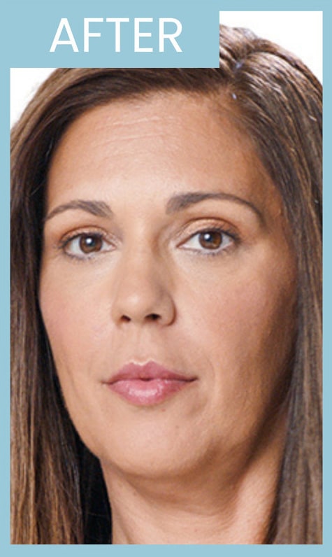 After Image: Juvederm Ultra XC - front