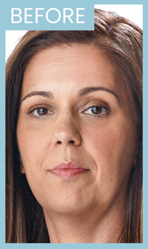 Before Image: Juvederm Ultra XC - front