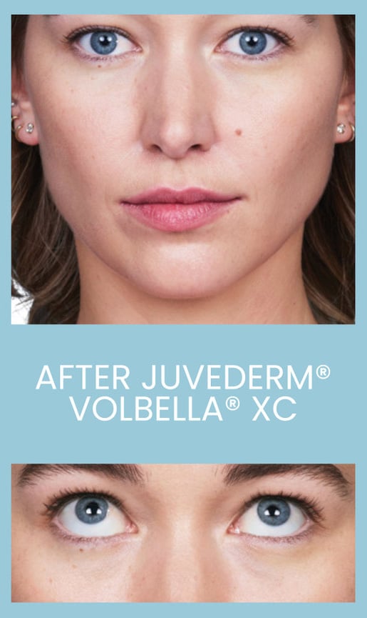 After Image: Juvederm Volbella XC - front