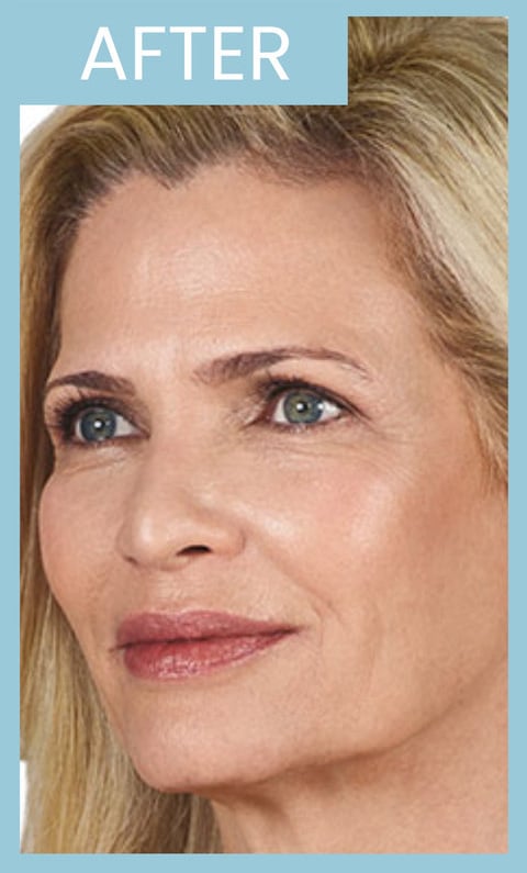 After Image: Juvederm Volbella XC - left-front-oblique