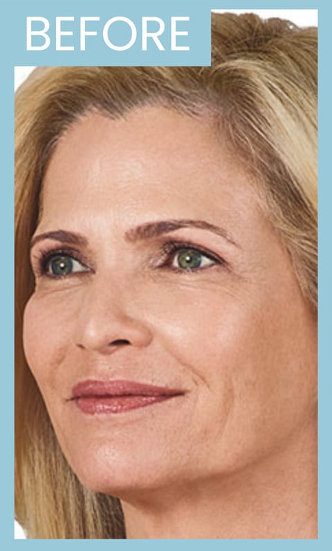 Before Image: Juvederm Volbella XC - left-front-oblique