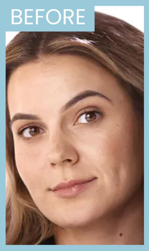 Before Image: Dermal Filler - front