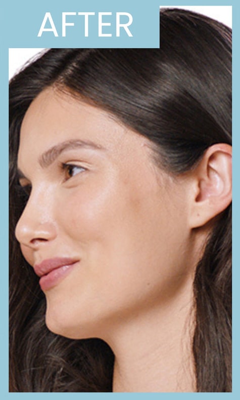 After Image: Juvederm Vollure XC - left-front-oblique
