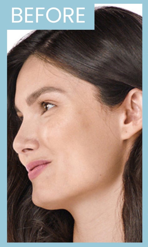 Before Image: Juvederm Vollure XC - left-front-oblique