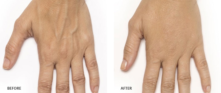 BeforeAfter radiesse hand gabby