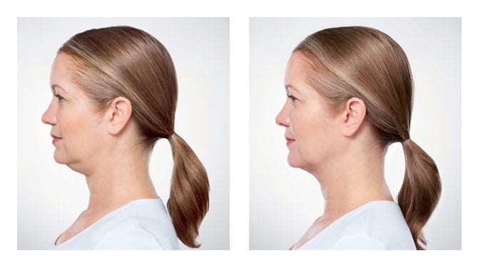 Kybella 18