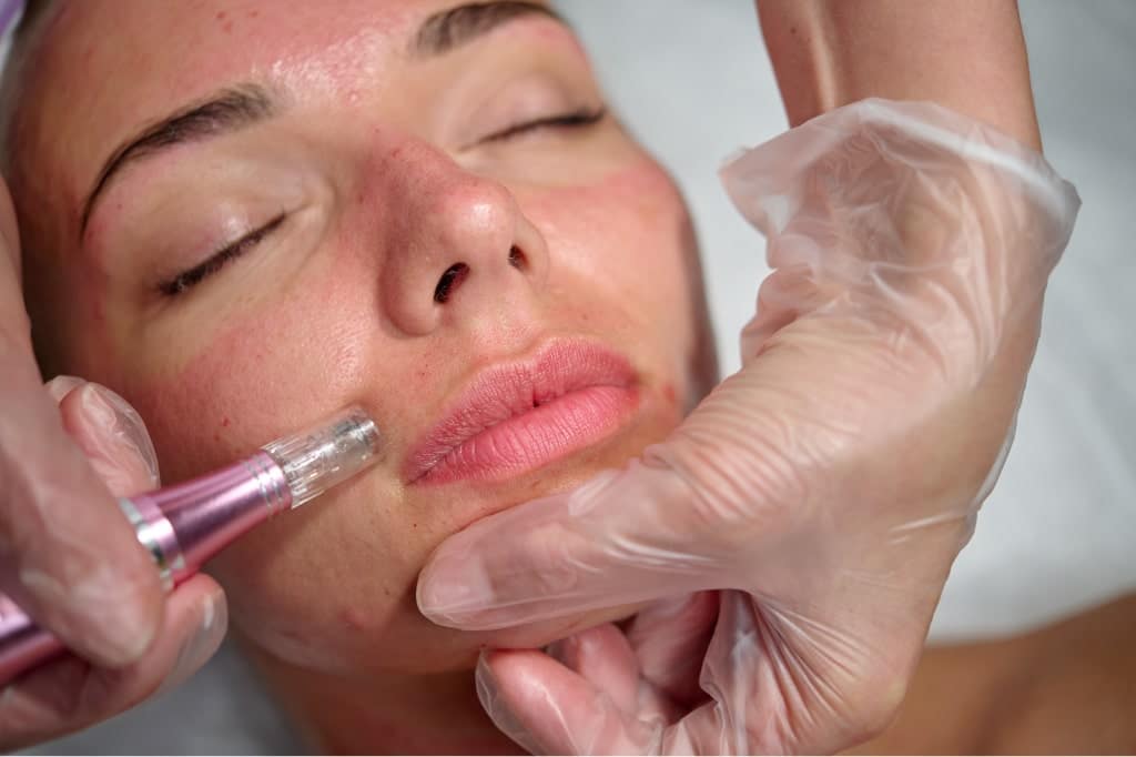 microneedling with prp vs microneedling