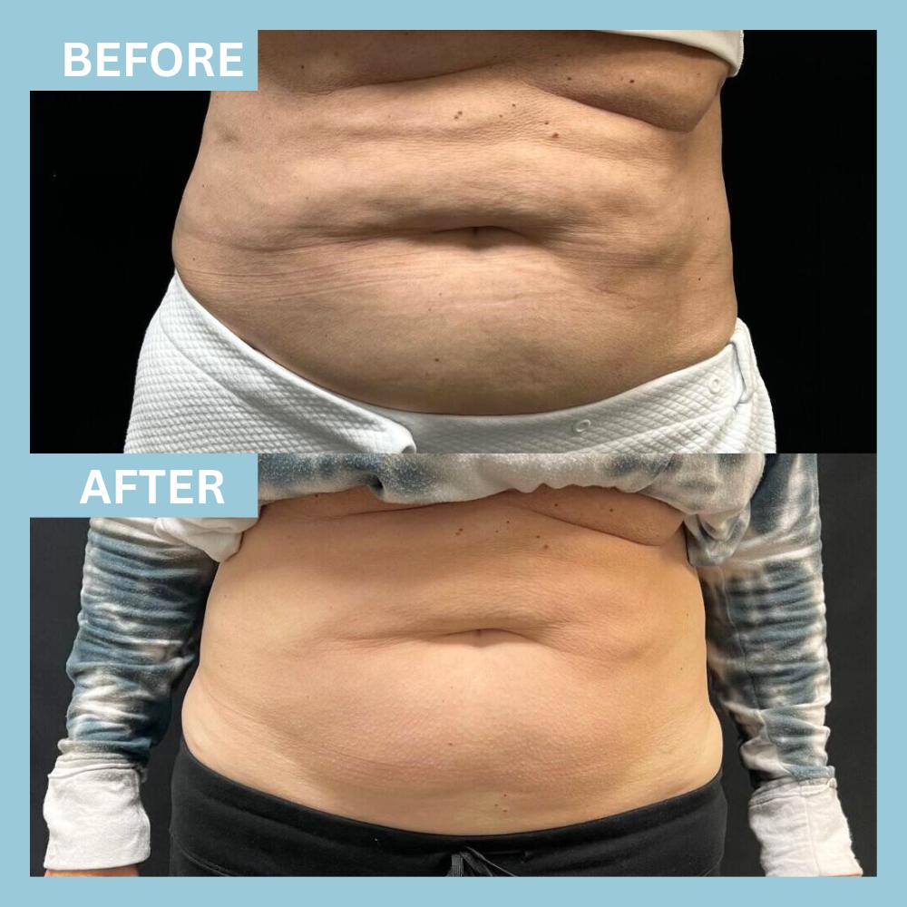 4EmsulptNeoTreatments