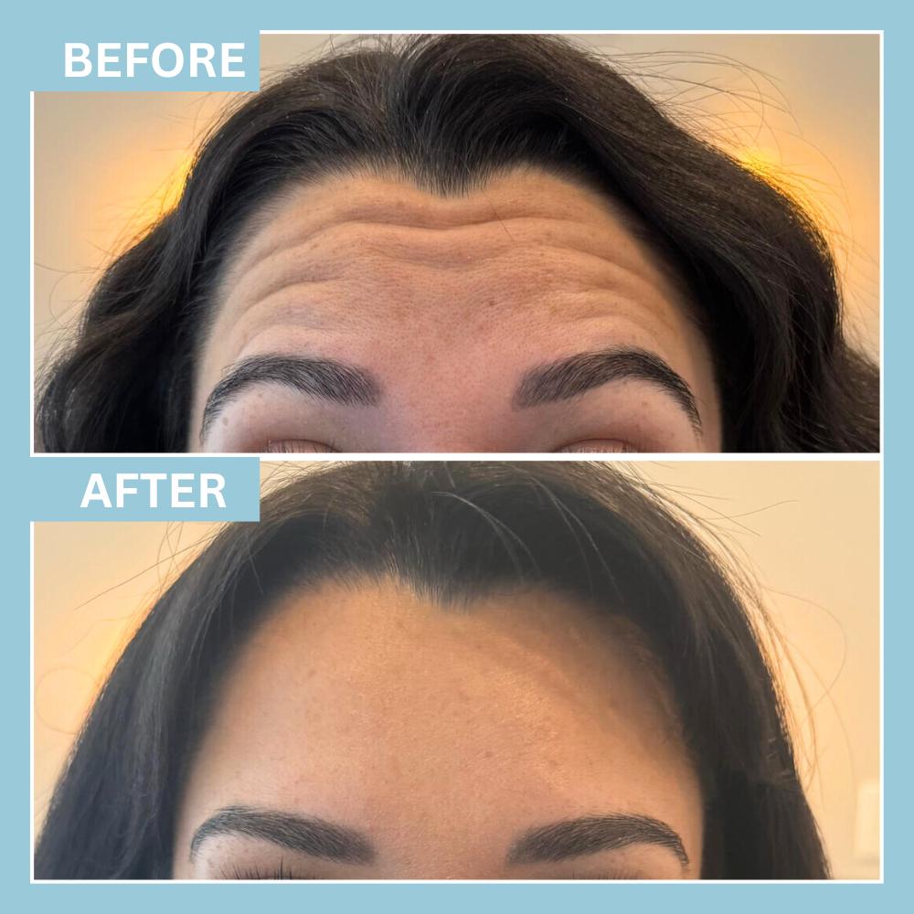 Botox2 Botox2