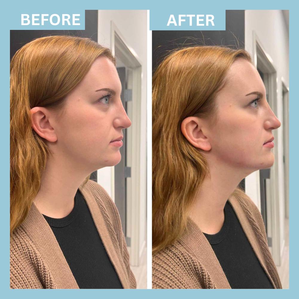 Chin Filler1 (2) Chin Filler1 (2)