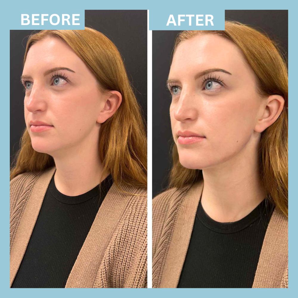 Chin Filler1 (3) Chin Filler1 (3)