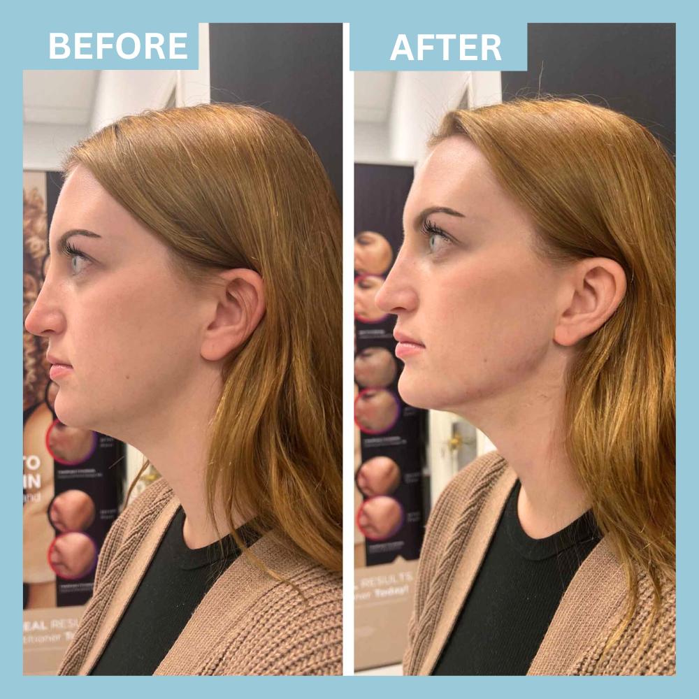 Chin Filler1 (4) Chin Filler1 (4)