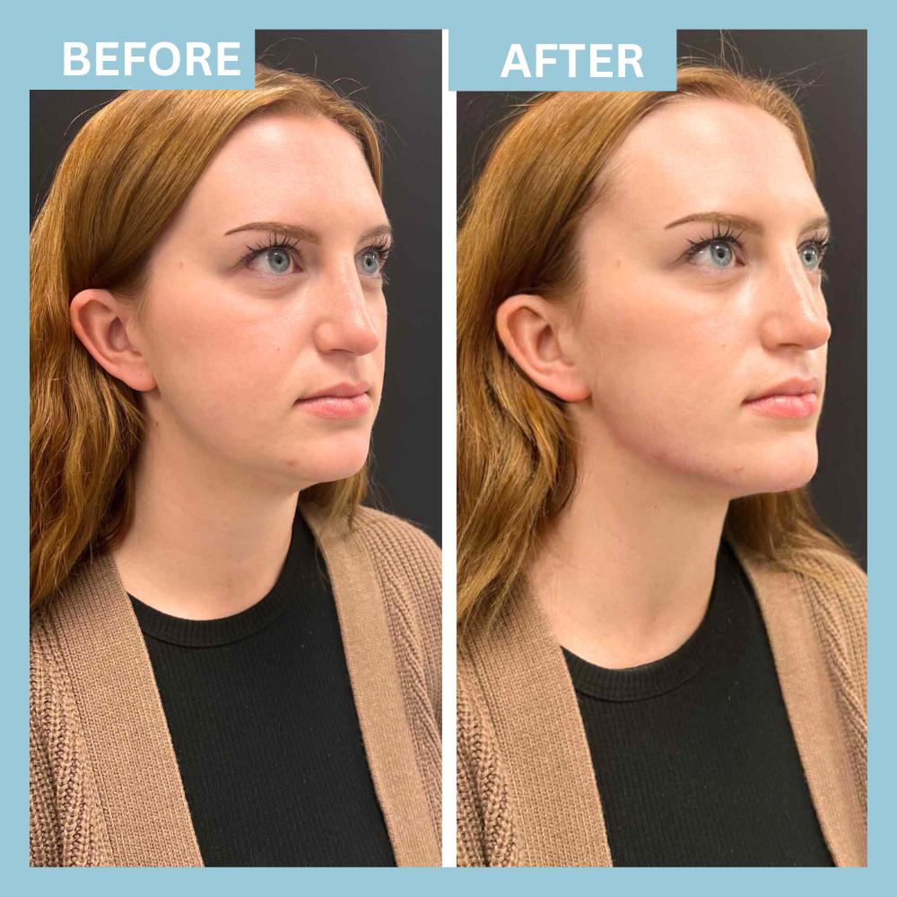 Chin Filler1 Chin Filler1