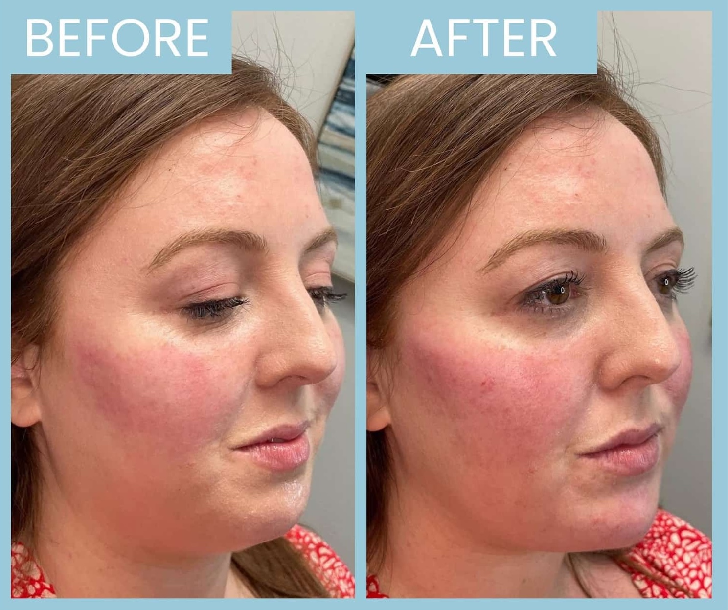 Chin and cheek filler1