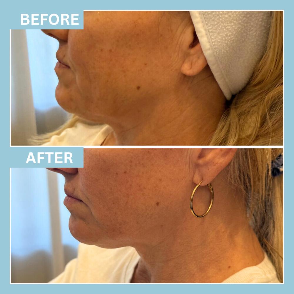 JawlineFiller1 JawlineFiller1