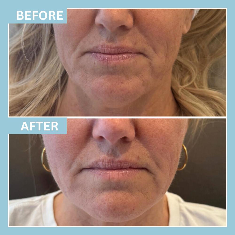 JawlineFiller2 JawlineFiller2