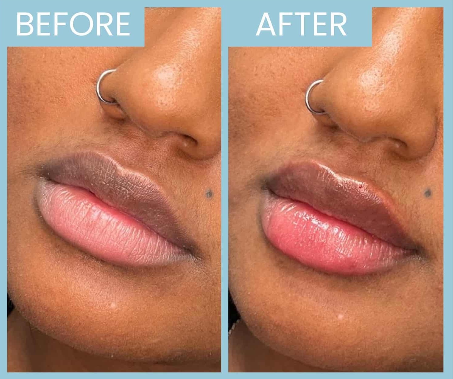 Lip filler8