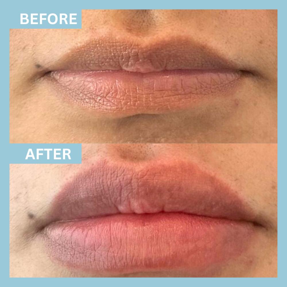 LipFiller1 LipFiller1