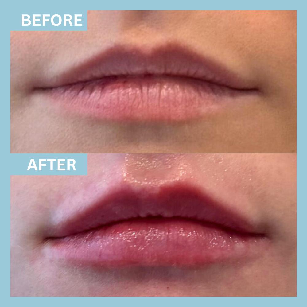 LipFiller2 LipFiller2