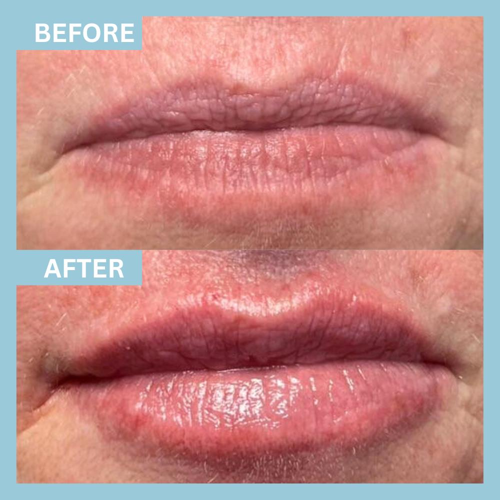 LipFiller3 LipFiller3