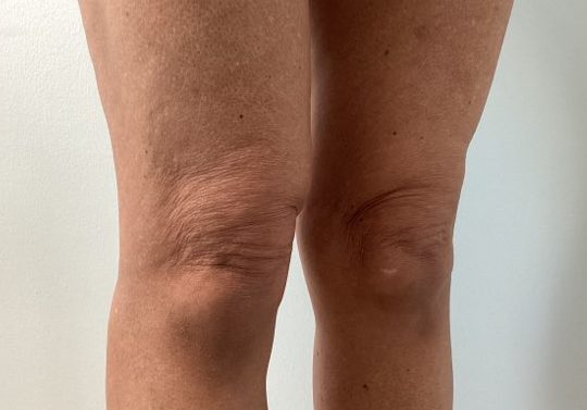 genius rf microneedling knees before e1701362366450