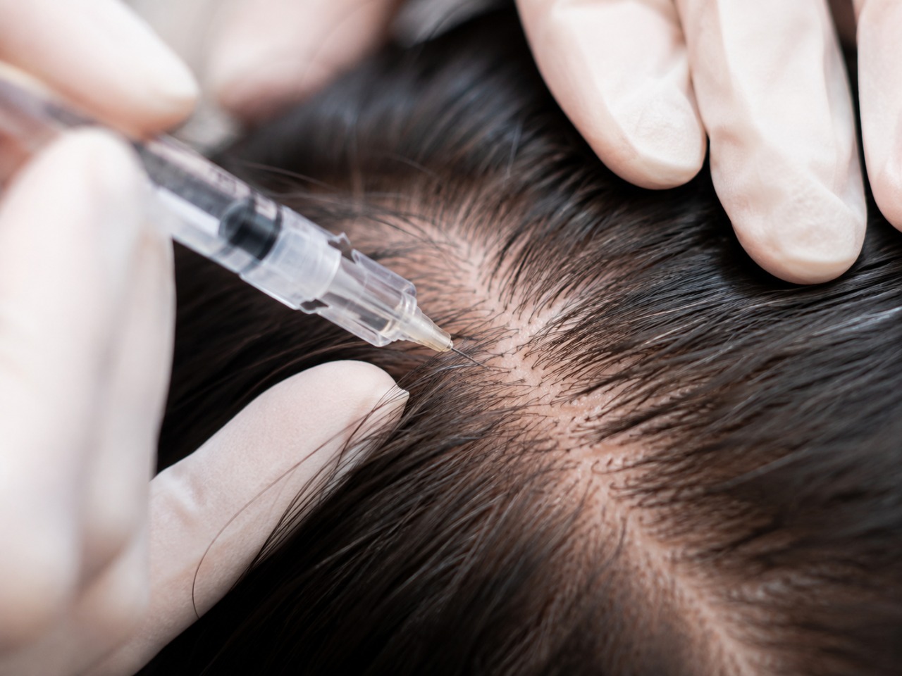 how prp hair restoration works